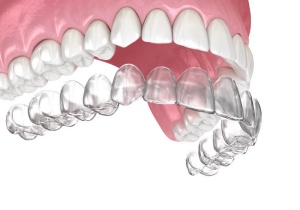 Invisalign Braces